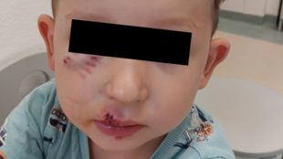 Dvouletého chlapečka v Havířově pokousal pes, policie hledá majitele