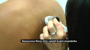 Nemocnice Nový Jičín vyšetří kožní znaménka