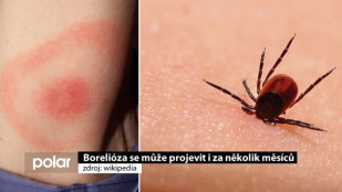 Borelióza se může projevit i za několik měsíců