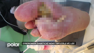 Syndromem diabetické nohy trpí stále více lidí