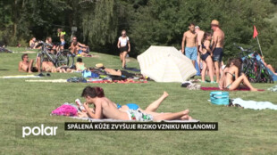 Spálená kůže zvyšuje riziko vzniku melanomu