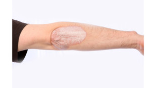 Na léčbu lupénky vydala ČPZP loni téměř 93 milionů korun