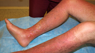 Vážné popáleniny může způsobit i slunce, varují lékaři