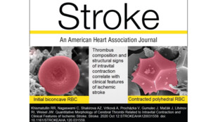 Americký odborný časopis Stroke publikoval výsledky výzkumu týmu, jehož součástí jsou lékaři FNO