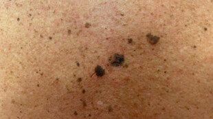 Lékaři Fakultní nemocnice Ostrava zaznamenali nárůst u kožních nádorů