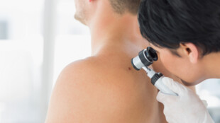 Kampaň proti melanomu opět nabídne vyšetření zdarma v 15 městech