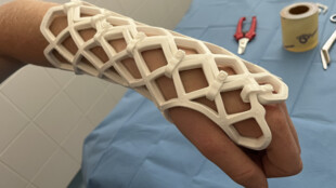 Fixace zlomeniny prodyšnou ortézou z karbonu přináší pacientům komfort hlavně v létě