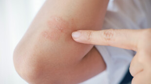 Na léčbu lupénky vydala ČPZP loni téměř 200 milionů korun