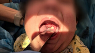 Infektologové FN Ostrava během dvou měsíců léčili tři pacienty se záškrtem