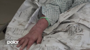 Zdravotní stav těžce popáleného horníka se výrazně zlepšil